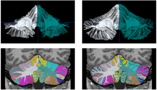 ИИ научился анализировать мозжечок по снимкам МРТ