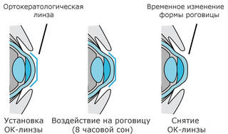 Улучшить зрение можно без операции: как работают ночные линзы для лечения глаз