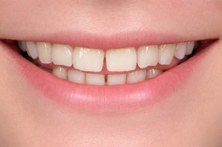 3 признака того, что вы скрипите зубами во сне