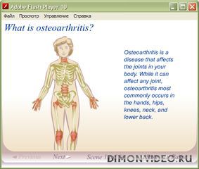 osteoarthritis